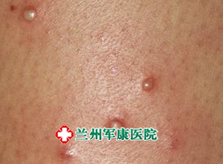毛囊炎症状图片